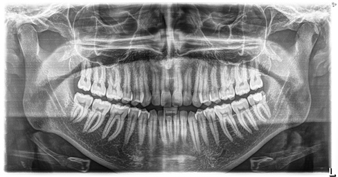 opg dental x ray