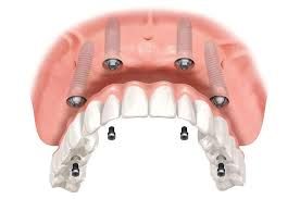 All on 4 implants